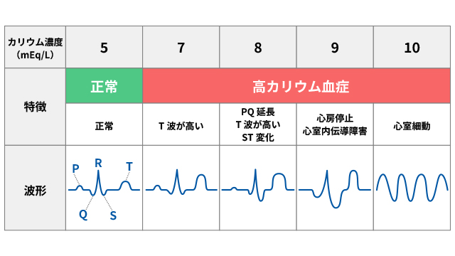 高カリウム血症の心電図の特徴はどのようなものですか？ ｜高カリウム血症