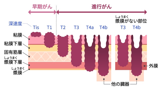 大腸がんの進行度を判定する深達度（浸潤の深さ）を示した断面図。粘膜にとどまる早期がんから、固有筋層や漿膜を超えて他臓器へ広がる進行がんまでの段階的な変化を描いた病理模式図。
