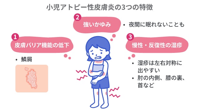 小児アトピー性皮膚炎の3つの特徴を示すイラスト。体を掻く子どもの姿と共に、皮膚バリア機能の低下、強いかゆみ、慢性・反復性の湿疹という3つの特徴を解説しています。