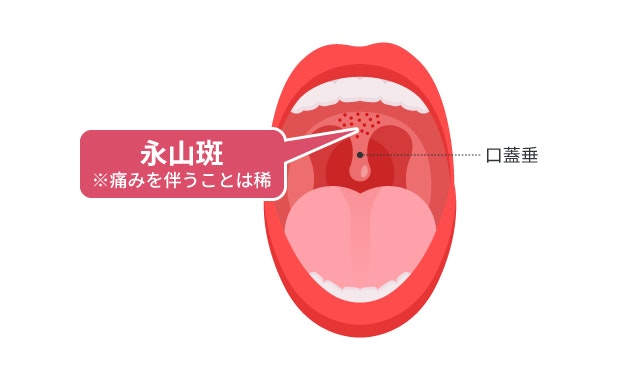 突発性発疹の永山斑を説明する図です