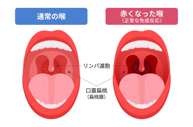 喉の奥に見える赤いぶつぶつを説明する図です