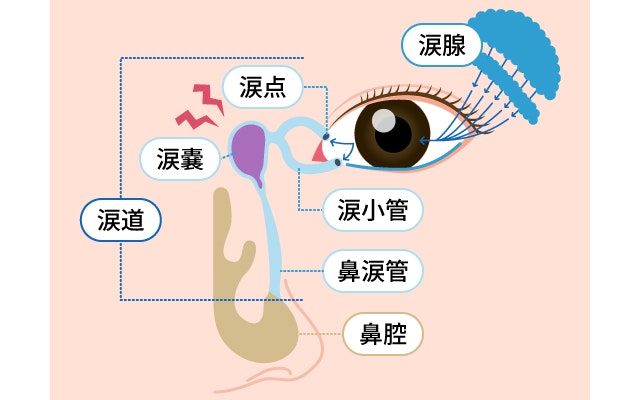急性涙嚢炎を説明する図です