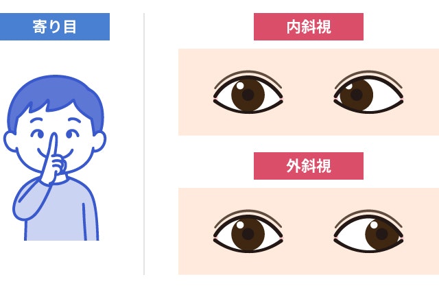 寄り目と斜視の違いを説明する図です