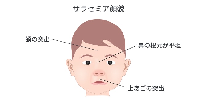 サラセミア顔貌の特徴を示すイラスト。子どもの正面顔を描き、突き出た額、平坦な鼻の根元、突出した上あごという特有の骨格変化を具体的に表現しています。