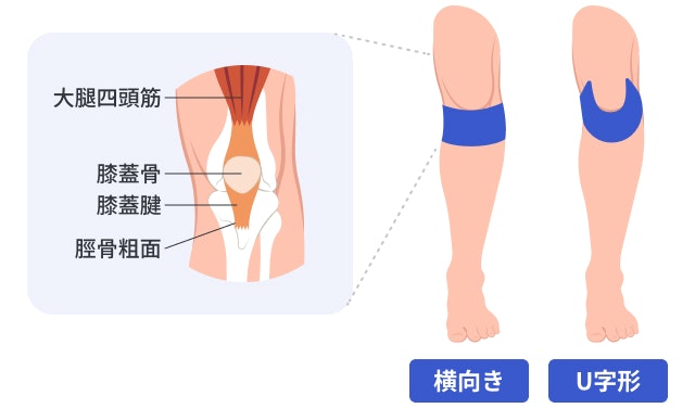 オスグッドと診断されたときにおすすめのテーピング方法を説明する図です