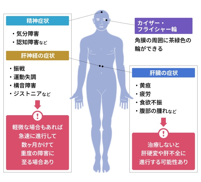 ウィルソン病の特徴のイラスト