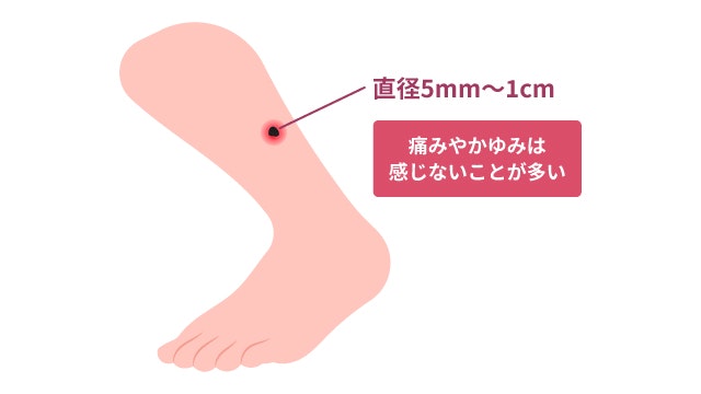 恙虫(ツツガムシ)病の刺し口の見た目ついて説明する図です。