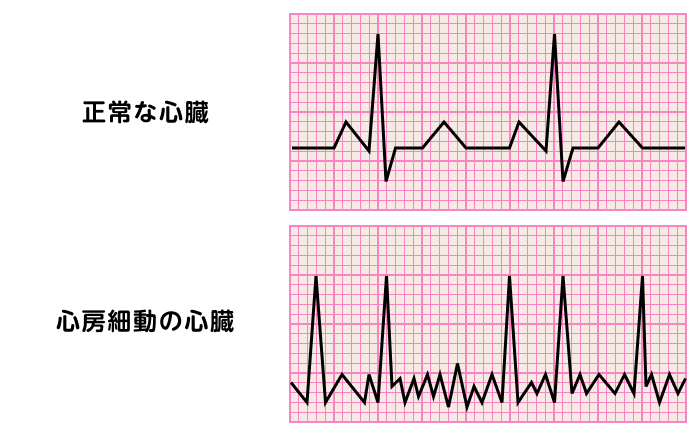 心房細動の心電図を説明した図です。