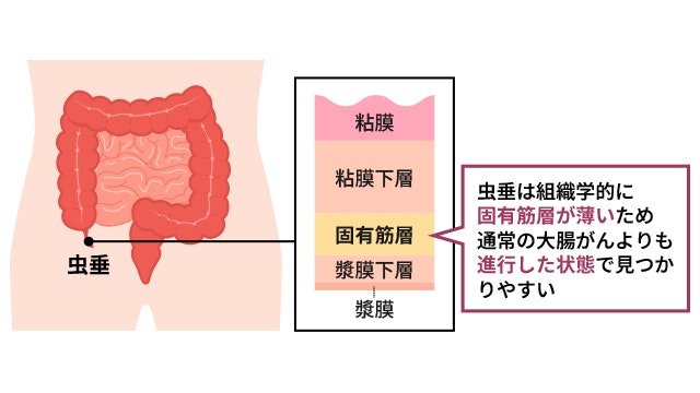 虫垂癌を説明する図です