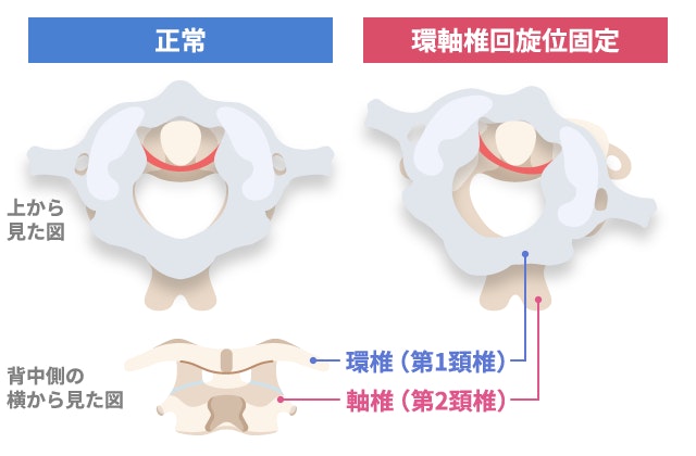 環軸椎回旋位固定（AARF）と正常な頸椎の構造比較イラスト。左側の「正常」に対し、右側では環椎（第1頸椎）が軸椎（第2頸椎）に対して回旋し、ずれた位置で固定されている様子を「上から見た図」と「背中側の横から見た図」で図解。