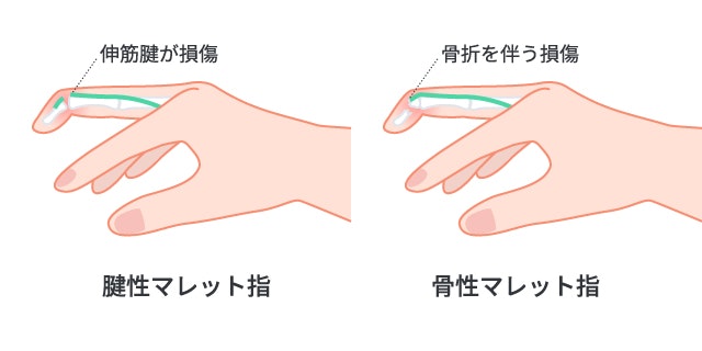 槌指（マレットフィンガー）の症状について説明する図です