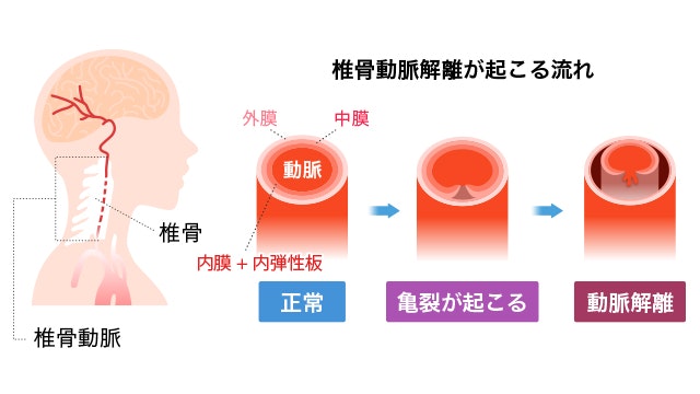 椎骨動脈解離が起こる過程を示した図です。