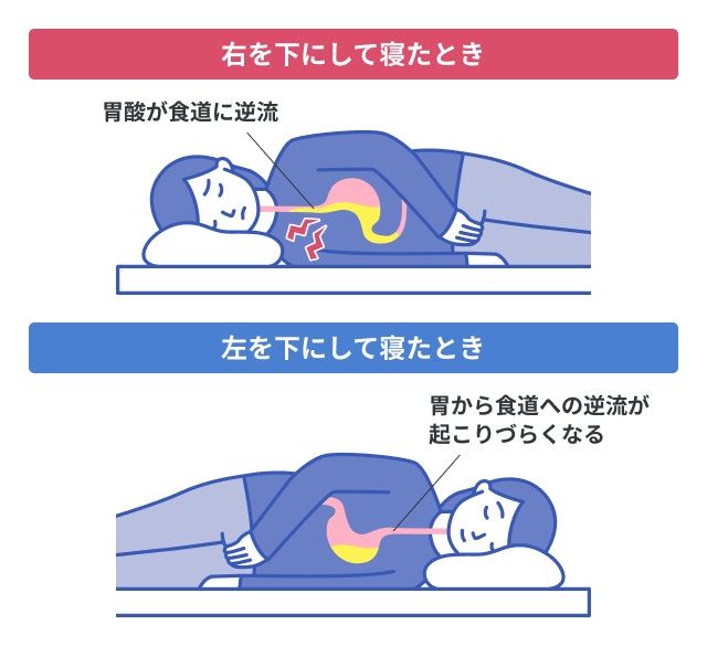 逆流性食道炎の方の寝るときの姿勢を説明する図です