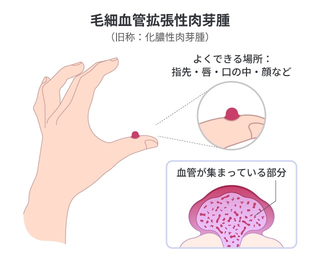 化膿性肉芽腫を説明する図です