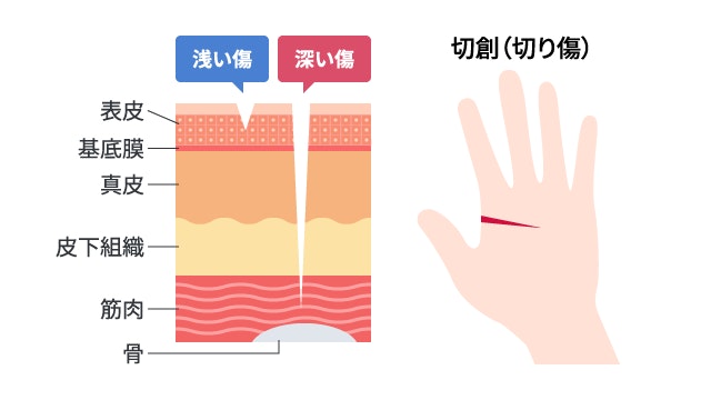 切創(切り傷)の深さによる損傷範囲の違いを示す比較断面図。浅い傷は表皮、深い傷は皮下組織を超えて筋肉まで達する様子を、手のひらの全体図と合わせて詳細に描写しています。
