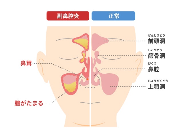 副鼻腔炎を説明する図です