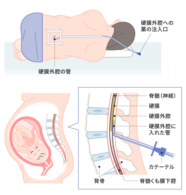 硬膜外鎮痛と麻酔 : 理論から手技の実際まで 硬膜外鎮痛と麻酔 | 高崎 眞弓 |本 | 通販 | Amazon