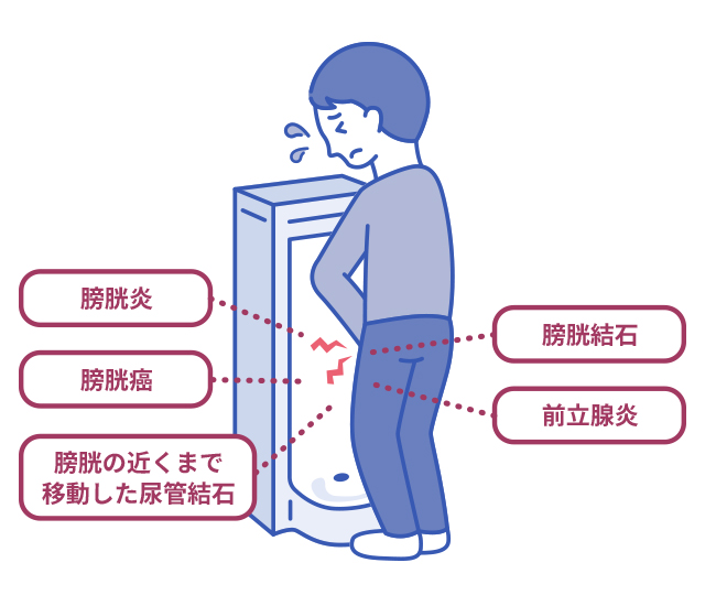 尿を出すときに痛みがある | あなたの症状の原因と関連する病気をAIで無料チェック