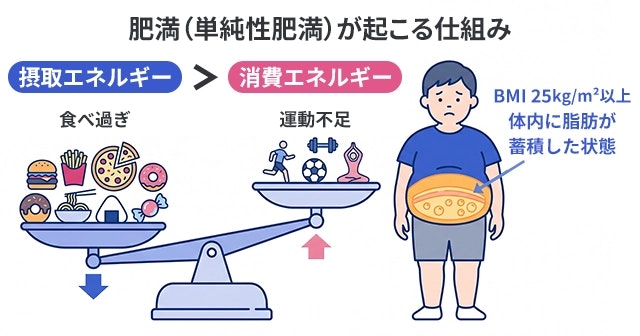 肥満（単純性肥満）が起こる仕組みとして、食べ過ぎによる摂取エネルギーが運動不足による消費エネルギーを上回る天秤の図と、BMI25以上で体内に脂肪が蓄積した男性の状態を解説したイラストです。