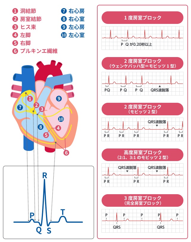 房室ブロックの心電図を説明する図です