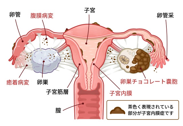 子宮内膜症が発生する場所についての図です