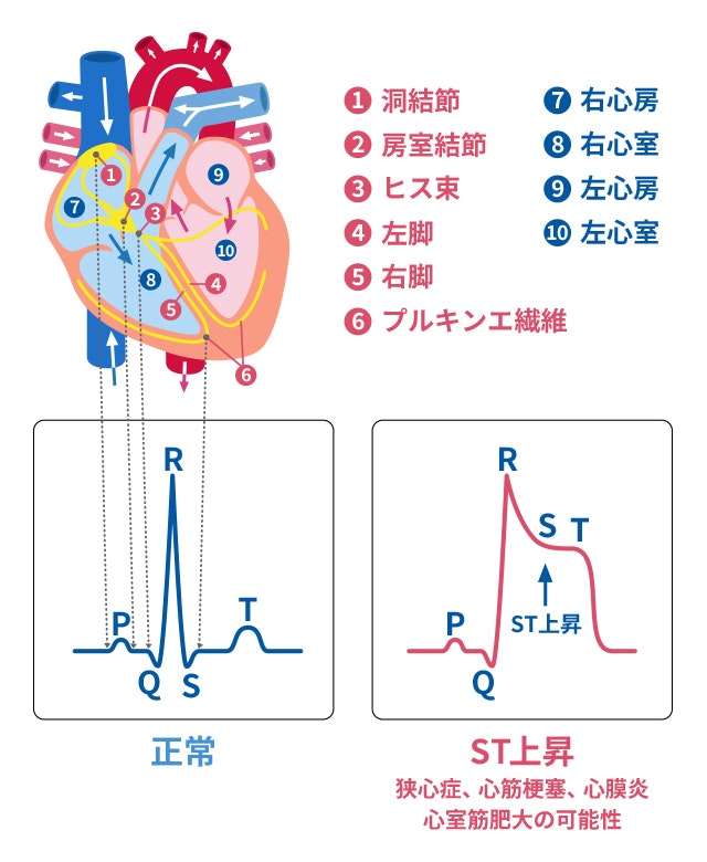 心電図のST上昇のイラスト