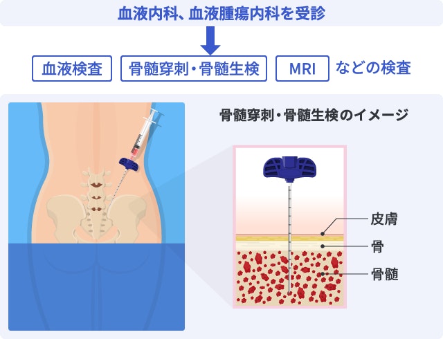再生不良性貧血における「骨髄穿刺・骨髄生検」の図解。左側には、検査台にうつぶせになった患者の腰の骨(腸骨)に針を刺している様子。右側に、拡大した断面図で皮膚と骨を貫通して内部の骨髄組織を採取している様子。