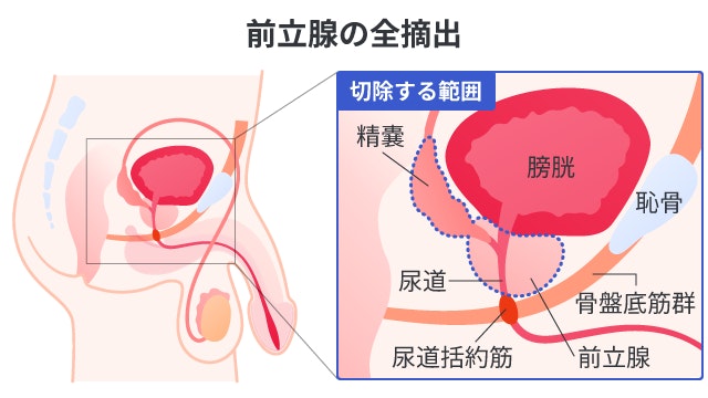前立腺がんの全摘出手術における切除範囲を示した断面図。前立腺と精嚢を取り除くため、膀胱や尿道、尿道括約筋などに影響があることを視覚的に解説しています。