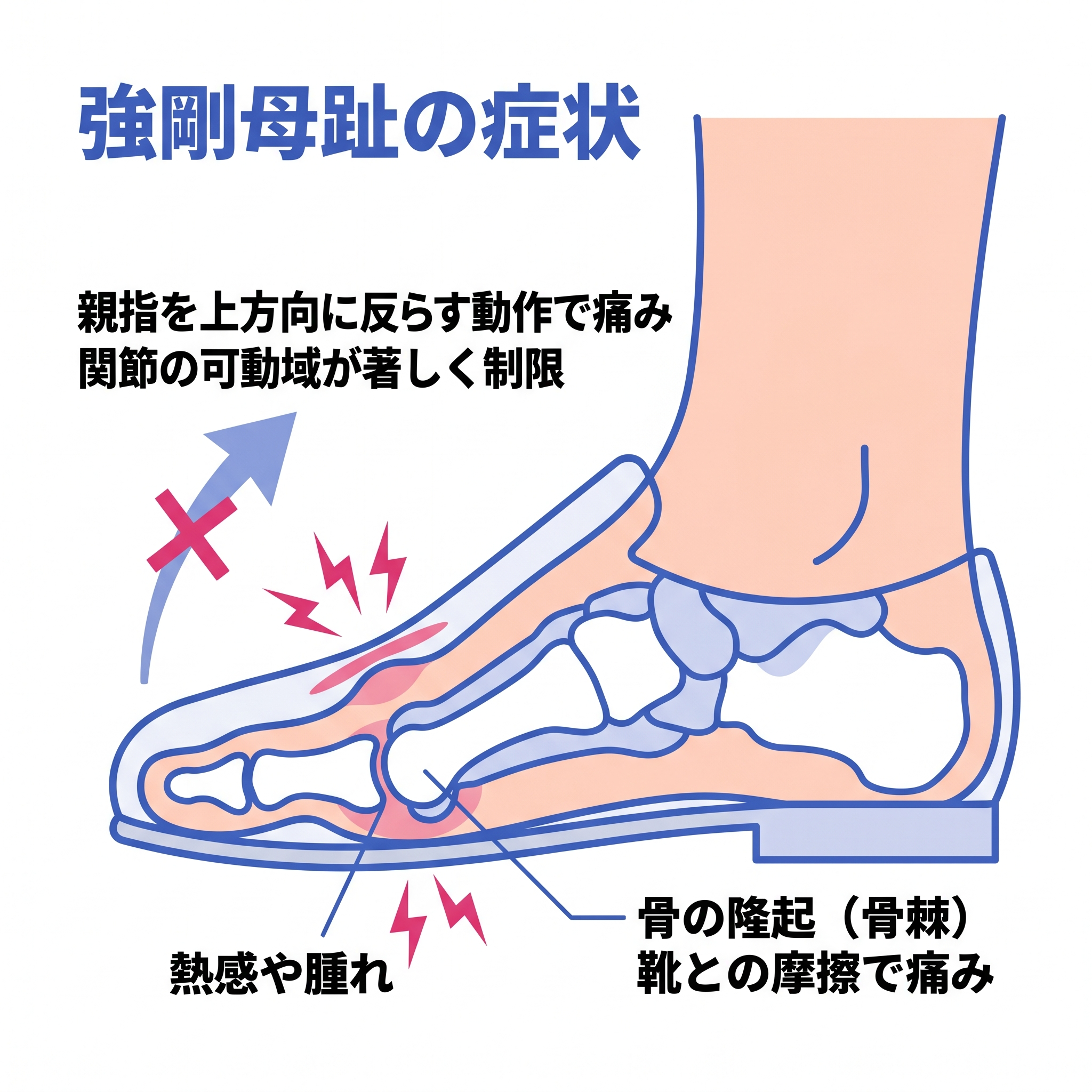 強剛母趾（きょうごうぼし）の主な症状を解説したイラストです。靴を履いた足の内部の骨格が描かれています。症状の特徴として、親指を上方向に反らす動作で痛みが生じ、関節の可動域が著しく制限されることが、バツ印のついた上向きの矢印で示されています。また、親指の付け根の関節部分（足の裏側）に「熱感や腫れ」が生じること、そして関節の上部（足の甲側）に「骨の隆起（骨棘：こつきょく）」ができ、「靴との摩擦で痛み」が発生することが記載されており、それぞれの部位に痛みを示す赤いマークが描かれています。