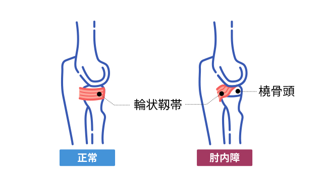 肘内障」とはどのような病気ですか？ ｜肘内障