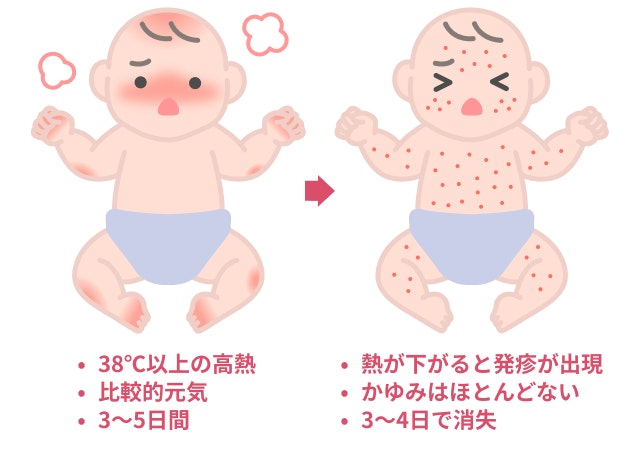 突発性発疹を説明する図です