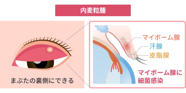 内麦粒腫によってまぶたの裏側に膿を含んだ赤いできものがある状態と、その原因となるマイボーム腺への細菌感染を断面図で解説したイラスト。