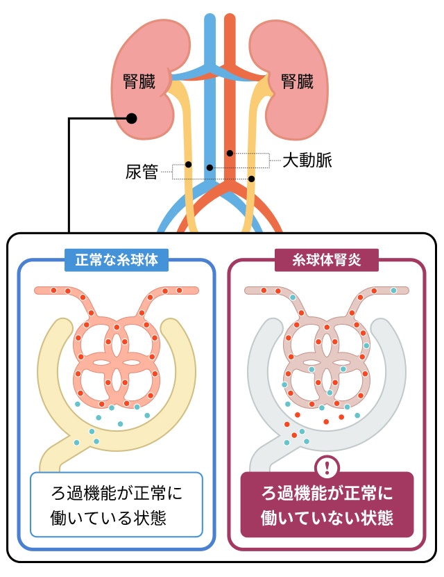 正常な糸球体と糸球体腎炎の腎臓を比較する図です