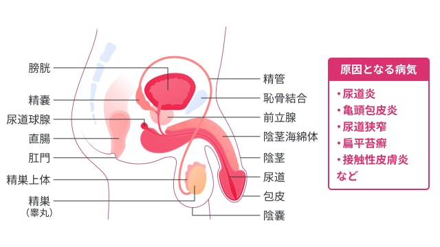 男性で尿道の出口が痒い場合は、尿道やその周囲に炎症があると考えられます。