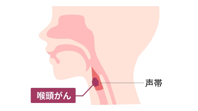 喉頭がんのイラスト