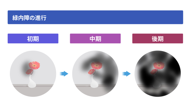 緑内障進行のイラスト