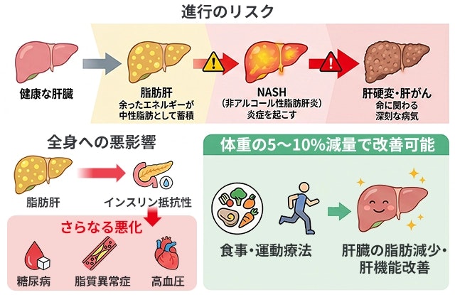 肥満症による脂肪肝では、NASH（非アルコール性脂肪肝炎）・肝硬変・肝がんに進行するリスクや、インスリン抵抗性による全身への悪影響があり、それらは減量で改善可能であることをイラストを用いてまとめています。