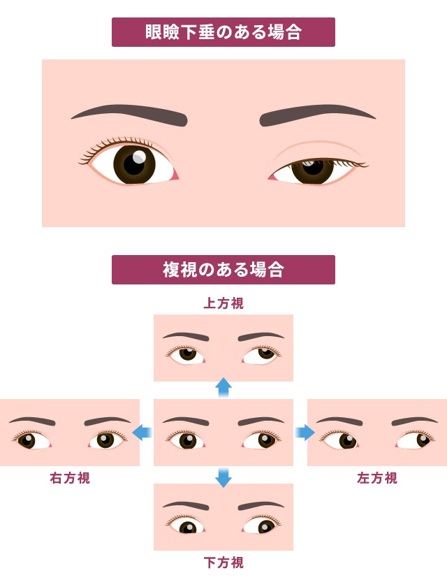 重症筋無力症を説明する図です