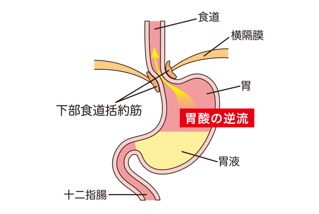 胃酸の逆流を示した図