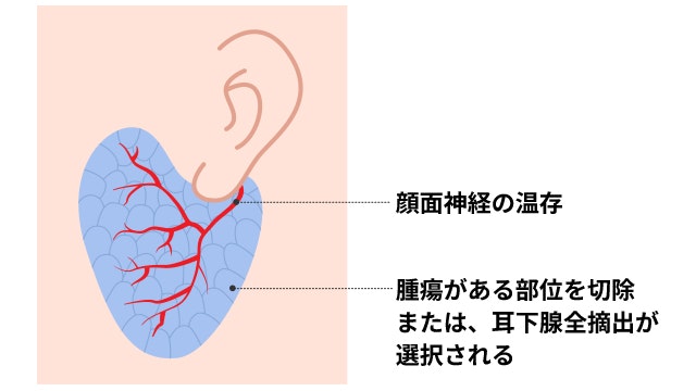 耳下腺癌を説明する図です