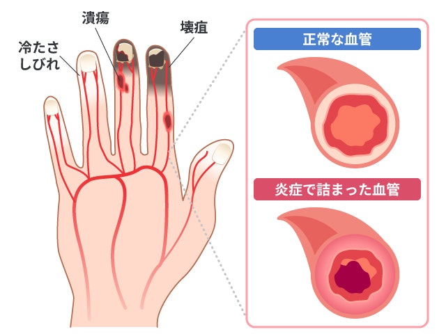 バージャー病の症状を説明する図です