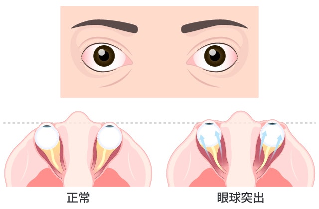 眼球突出を説明する図です