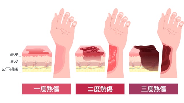 熱傷を説明する図です