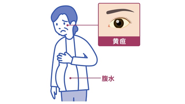 自己免疫性肝炎の症状を説明する図です