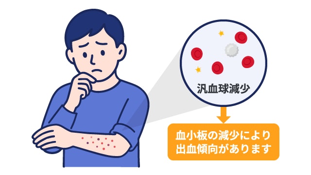 再生不良性貧血における血小板減少と出血症状のメカニズム図解。汎血球減少により血を止める血小板が不足し、出血傾向にある状態。男性が腕に生じた「点状出血（赤い斑点）」を見て異変に気づいているイラスト。