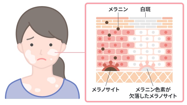 尋常性白斑を説明する図です