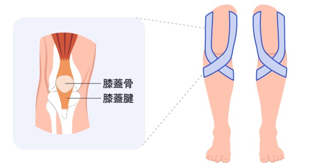 ジャンパー膝(膝蓋腱炎)の痛みを緩和するテーピングの貼り方と膝蓋腱の位置を示す解剖図。膝のお皿の下でテープを交差させ、患部にかかる負担を減らすサポート方法を描いたイラスト。