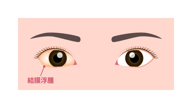 白目がぶよぶよについて説明する図です