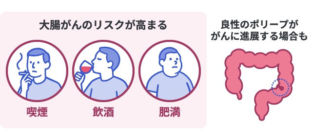 大腸がんの発症リスクを高める主な原因を示したイラスト。喫煙、飲酒、肥満といった生活習慣の要因に加え、大腸内の良性ポリープががんへ変化する可能性を描いた要因図。