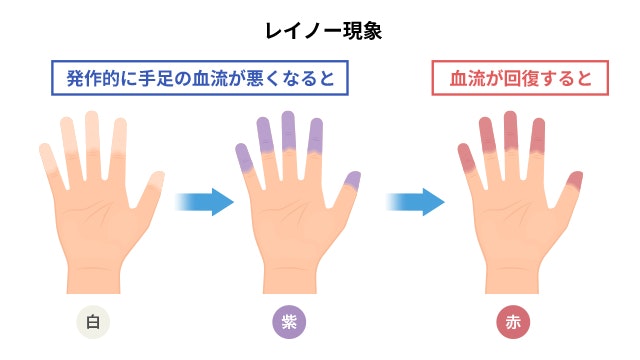レイノー現象でみられる指の色の変化を説明した図です。